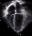 Child Echocardiogram (Echo)