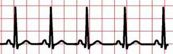 Child Electrocardiogram (EKG)